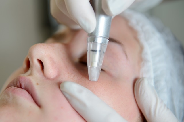 Treat Troubled Skin with Microdermabrasion