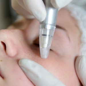 Treat Troubled Skin with Microdermabrasion